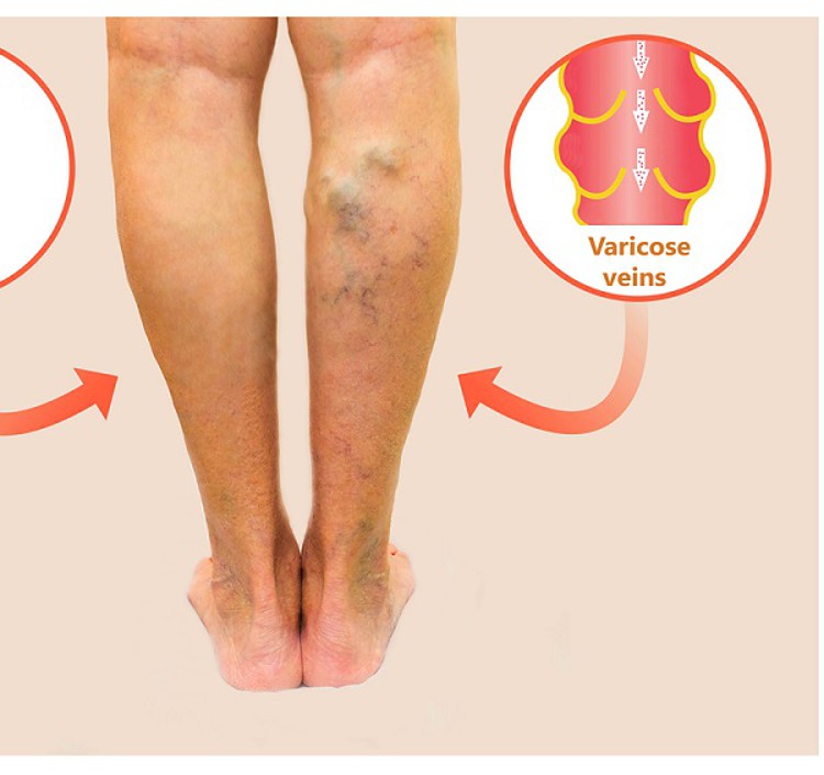 Varicose veins due to wrong sitting posture