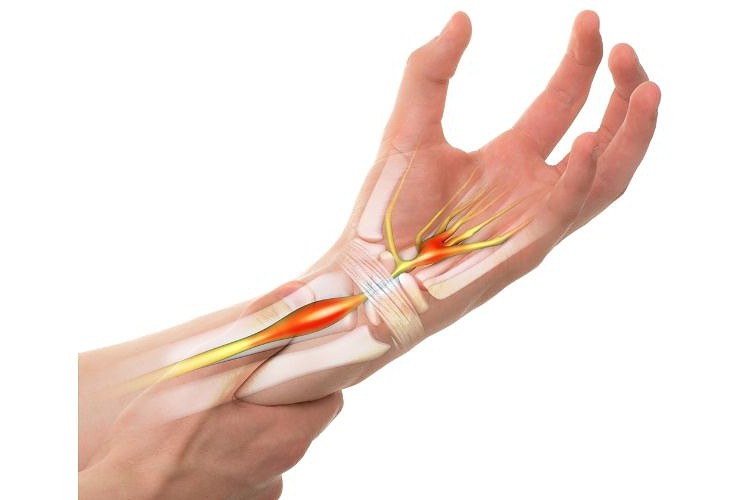 Carpal Tunnel Syndrome demonstrate picture