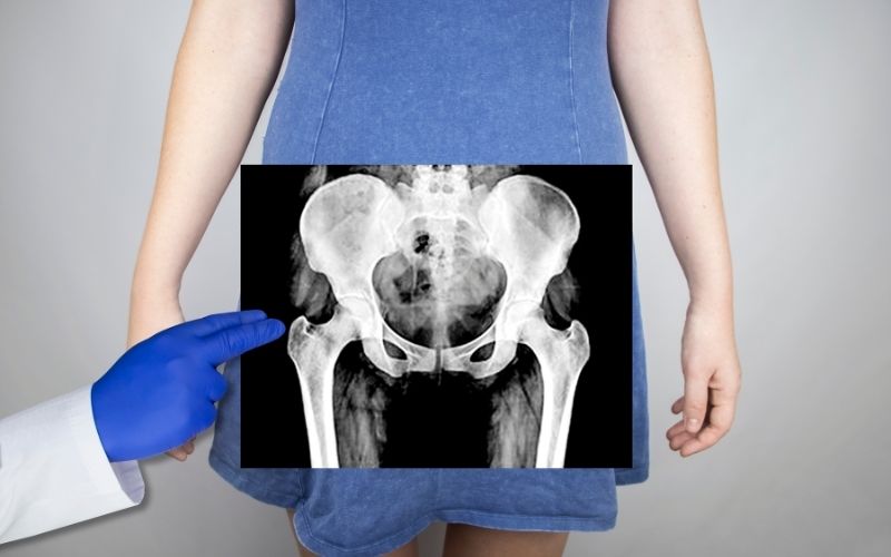 Woman with X-ray of her pelvic area