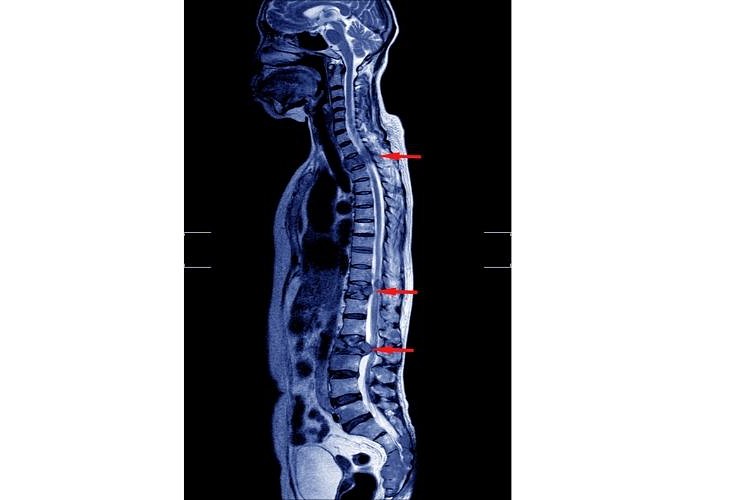 Decreased lumbar lordosis