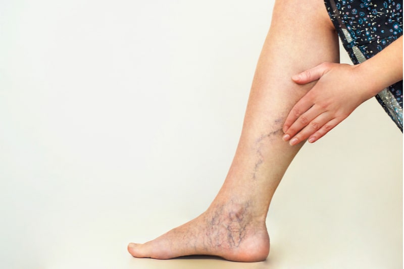 Woman suffered from varicose vein in her legs