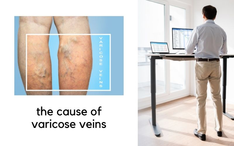 standing desks and the cause of varicose veins