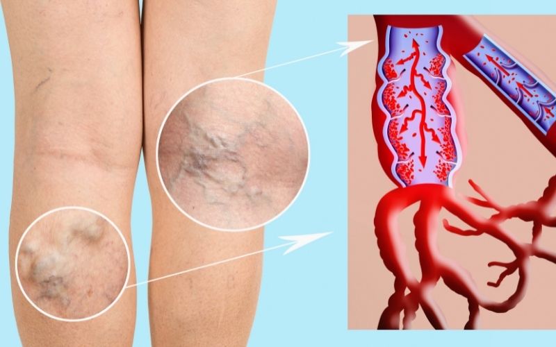 varicose veins